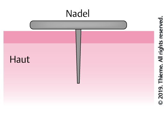 Abb. 4.15 Schematische Darstellung einer Dauernadel auf der Haut.