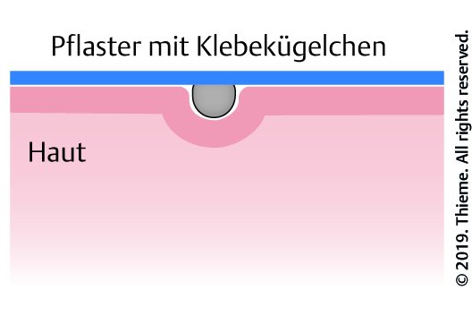 Abb. 4.16 Schematische Darstellung eines Klebekügelchens auf der Haut.